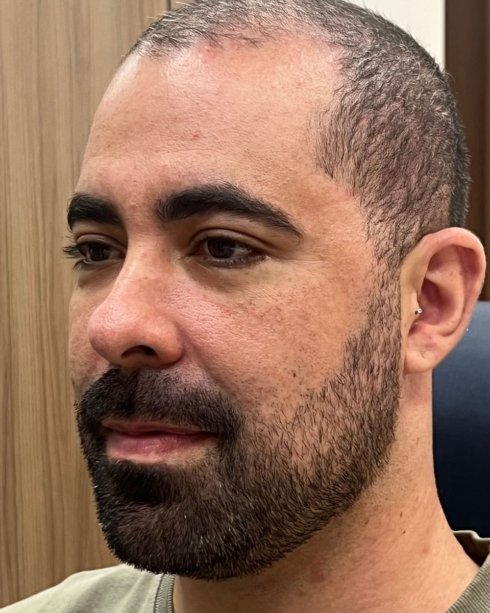 Rostro de un paciente en tres cuartos, antes del tratamiento