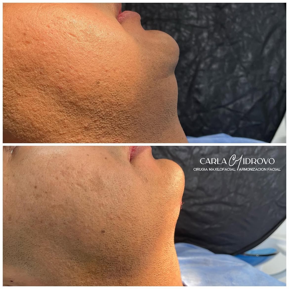 Contorno entre mentón y cuello antes (arriba) y después (abajo) de una lipopapada
