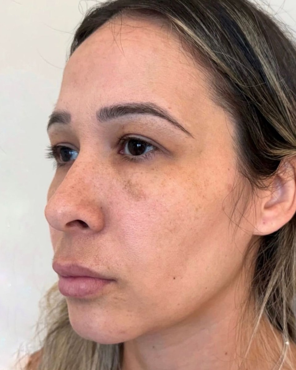 Rostro de una paciente en tres cuartos, antes del tratamiento
