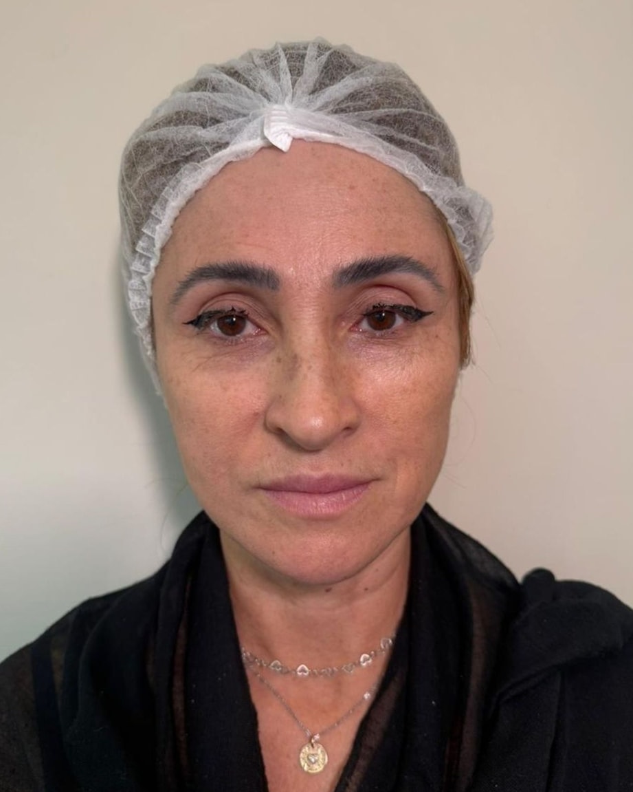 Rostro de una paciente de frente, antes del tratamiento