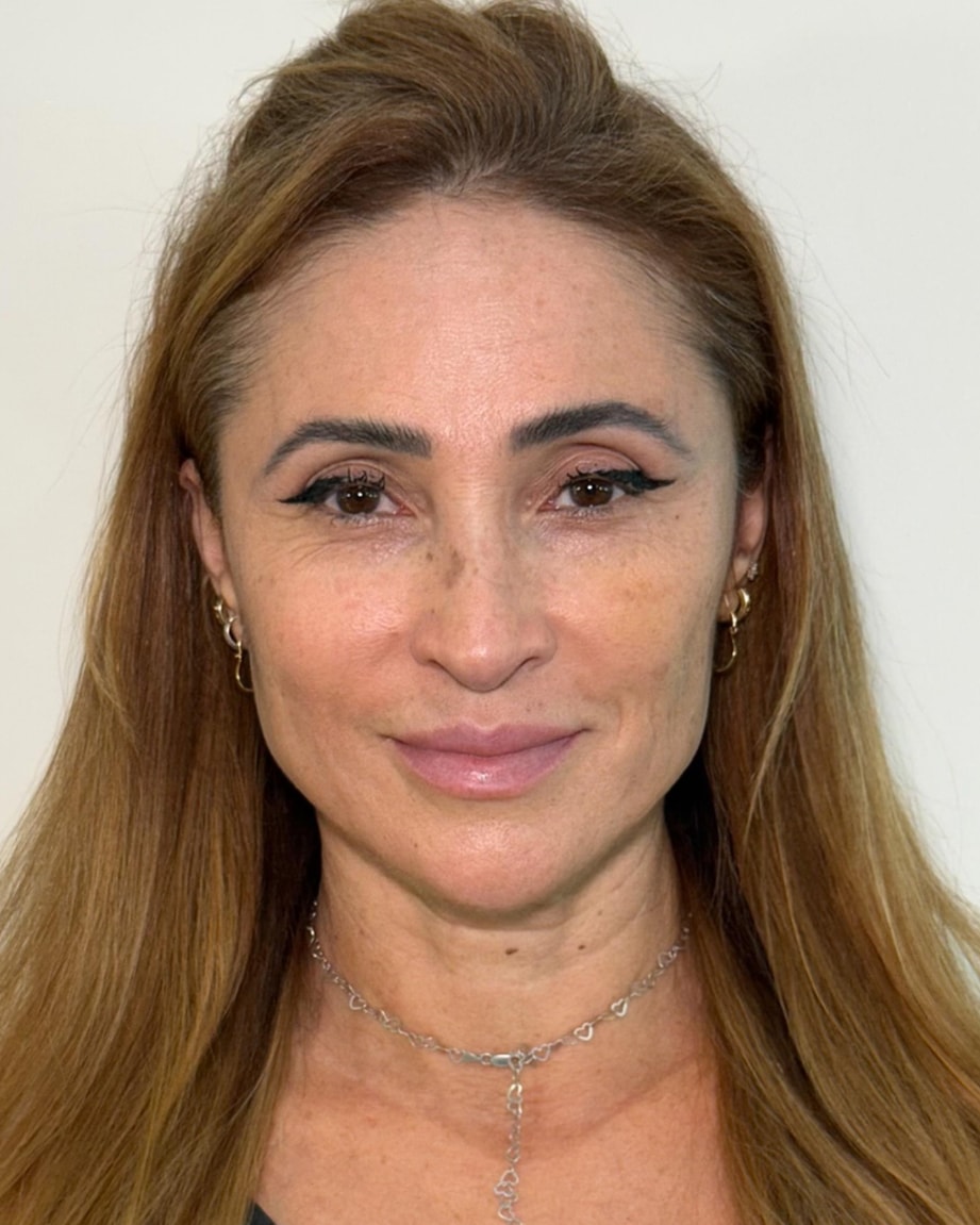 Rostro de una paciente de frente, después del tratamiento