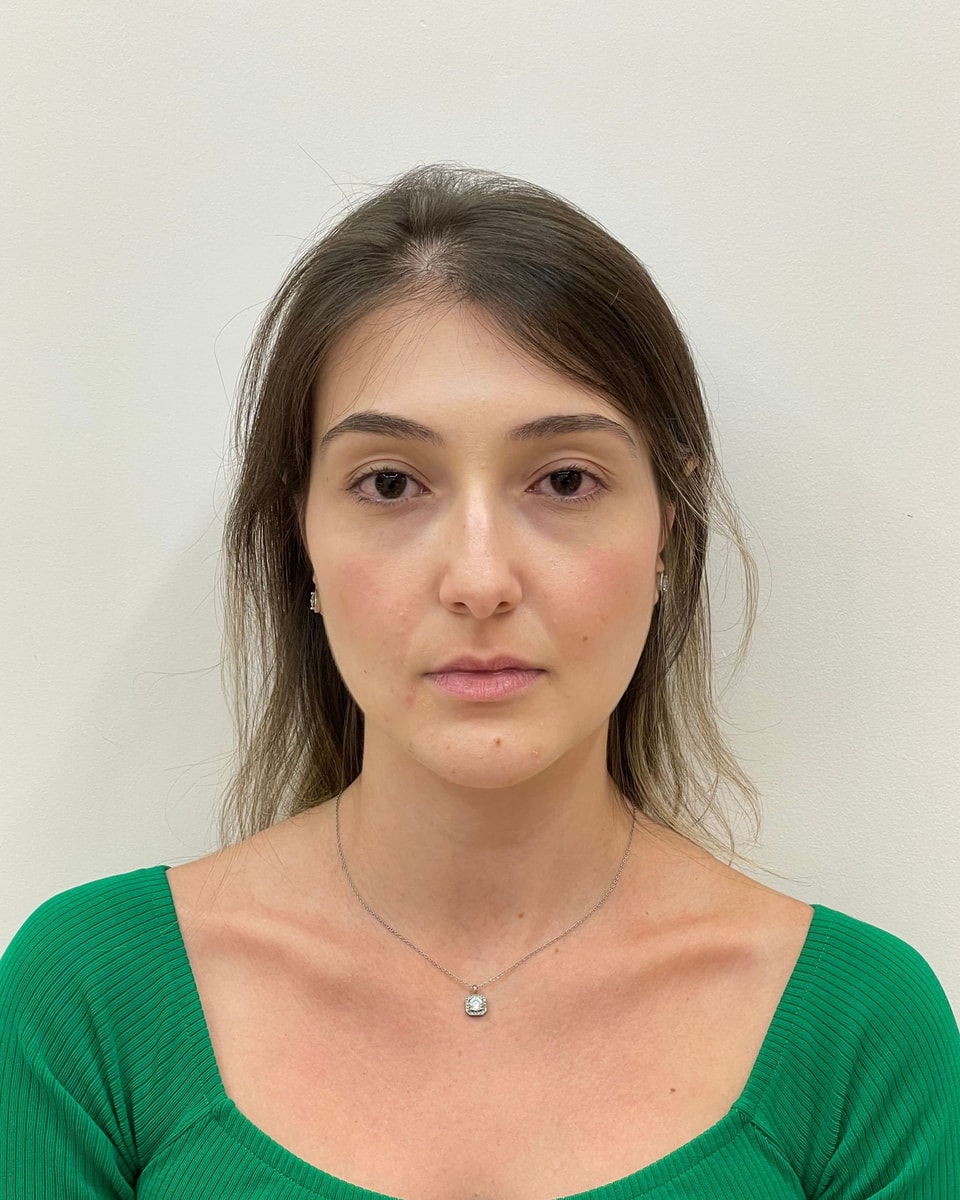 Rostro de una paciente de frente, antes del tratamiento